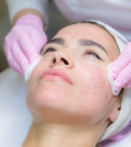 Laser Acne Scar Treatment
