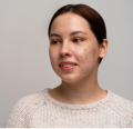 Customized Acne Scar Treatment Plans for Every Skin Type