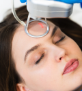 Laser Acne Scar Treatment